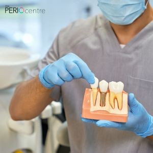 3 Common Myths About Dental Implants