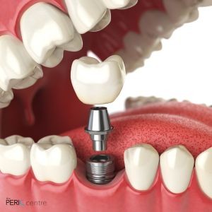 How to Prevent Plaque Buildup on Dental Implants