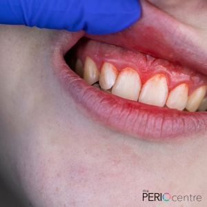 periodontal flap surgery