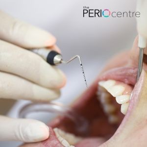 periodontal flap surgery